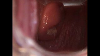 Avy開滑りと検鏡